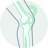 knee Injured Knee From Sprain, Strain, or Tear